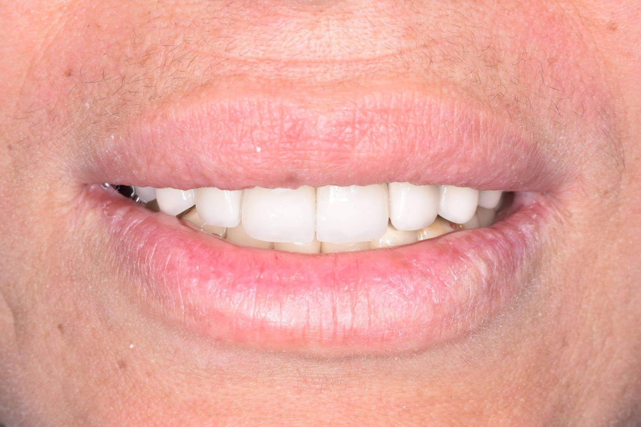 After — Full mouth restoration